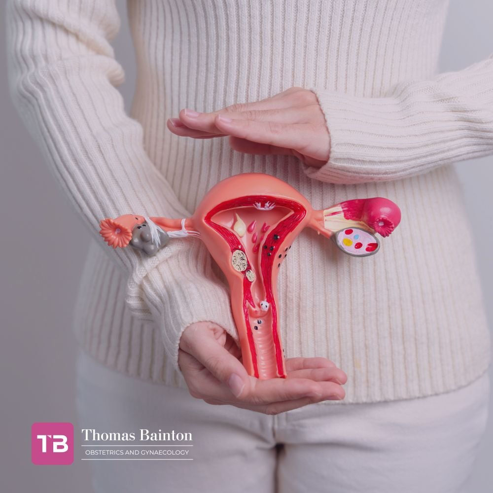 Fibroids Treatment in London - Thomas Bainton