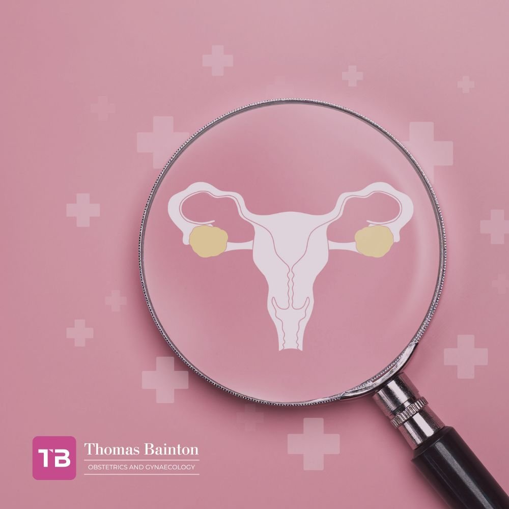Ovarian Cysts - Thomas Bainton
